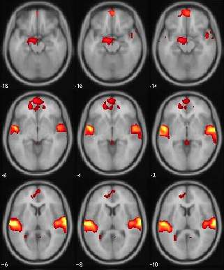 resonancia magnetica cerebral funcionales